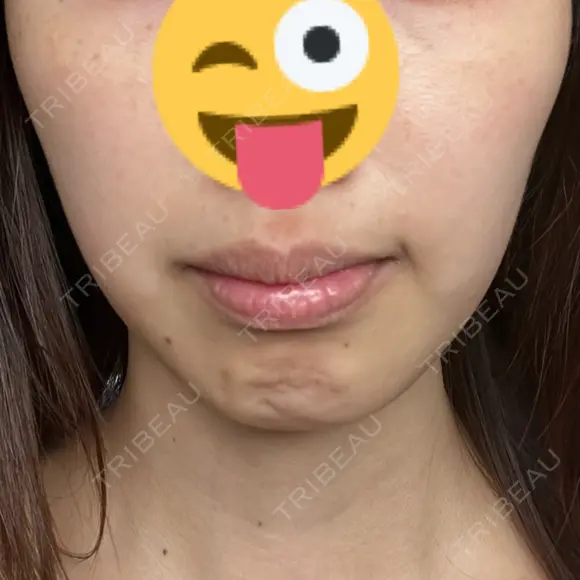 ボトックス（額） / その他（肌） Kaleido Clinic（カレイドクリニック） 横浜 DAY 3 メイン用