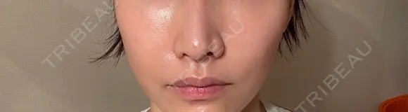 小鼻縮小（切開） 山本クリニック DAY 29 メイン用