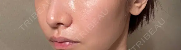 小鼻縮小（切開） 山本クリニック DAY 29 メイン用