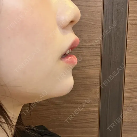 ヒアルロン酸注入（あご） ヴェリテクリニック 大阪院 DAY 7 メイン用