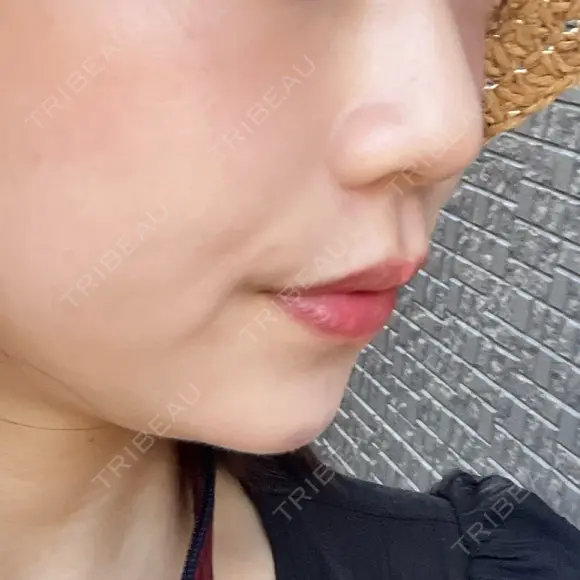 ヒアルロン酸注入（あご） ヴェリテクリニック 大阪院 DAY 7 メイン用