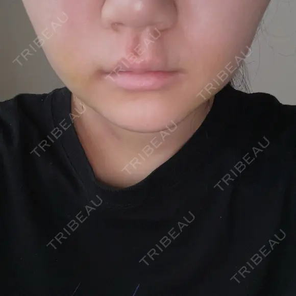 糸リフト / 脂肪吸引（顔） / ボトックス（エラ・小顔） ルラ美容クリニック 広島院 AFTER メイン用