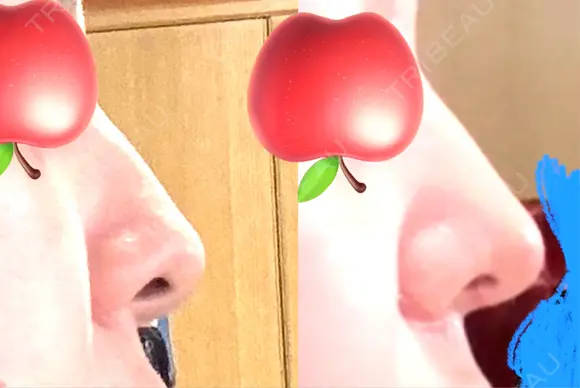 小鼻縮小（切開） / 鼻尖縮小 / 鼻柱下降・鼻唇角形成（猫手術） 東京シンデレラ美容外科 池袋院 DAY 14 メイン用