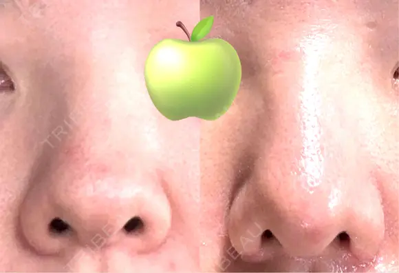 小鼻縮小（切開） / 鼻尖縮小 / 鼻柱下降・鼻唇角形成（猫手術） 東京シンデレラ美容外科 池袋院 DAY 14 メイン用