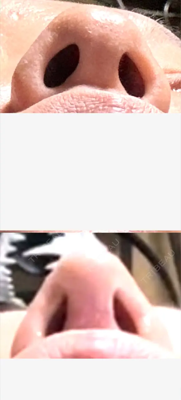 小鼻縮小（切開） / 鼻尖縮小 / 鼻柱下降・鼻唇角形成（猫手術） 東京シンデレラ美容外科 池袋院 DAY 14 メイン用