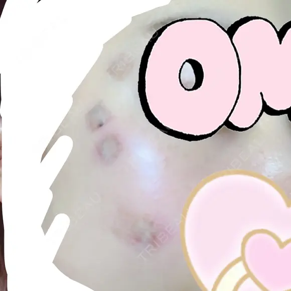 ほくろ・いぼ切除（肌） 赤坂メディカルMクリニック DAY 2 メイン用