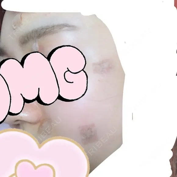 ほくろ・いぼ切除（肌） 赤坂メディカルMクリニック DAY 2 メイン用