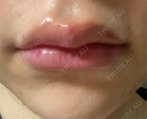 ヒアルロン酸注入（唇） REAL BEAUTY CLINIC 新宿東口院 AFTER メイン用