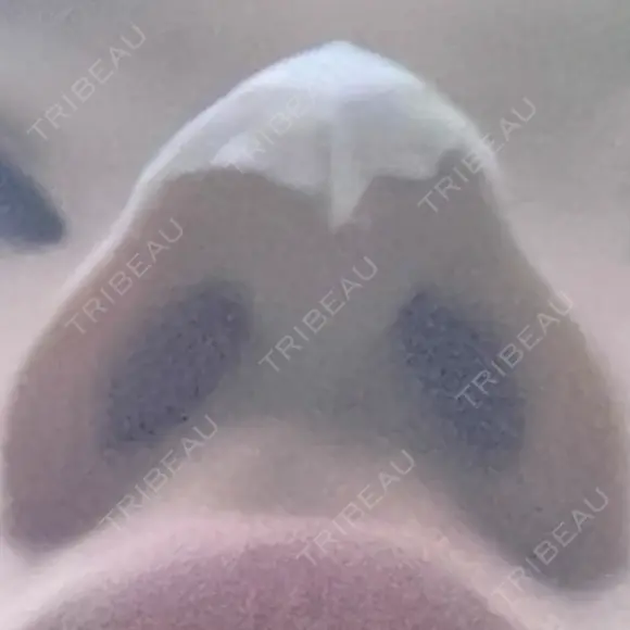 隆鼻術 / ヒアルロン酸注入（鼻） 渋谷美容外科クリニック 新宿院 DAY 0 メイン用