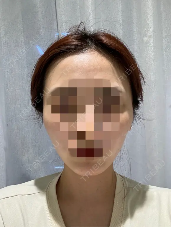 糸リフト / ボトックス（あご） / ヒアルロン酸注入（あご） Tokyo Tensei Clinic 銀座院 DAY 0 メイン用