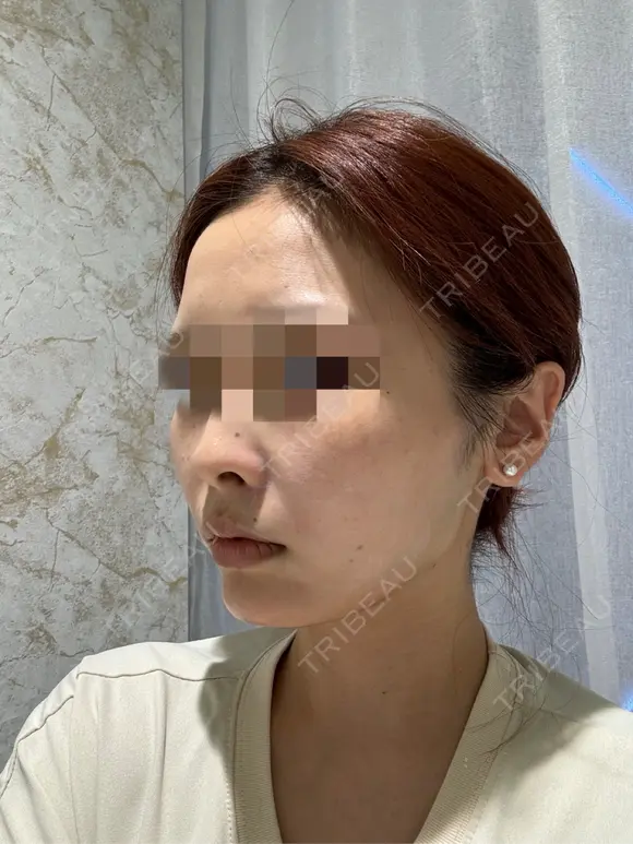 糸リフト / ボトックス（あご） / ヒアルロン酸注入（あご） Tokyo Tensei Clinic 銀座院 DAY 0 メイン用