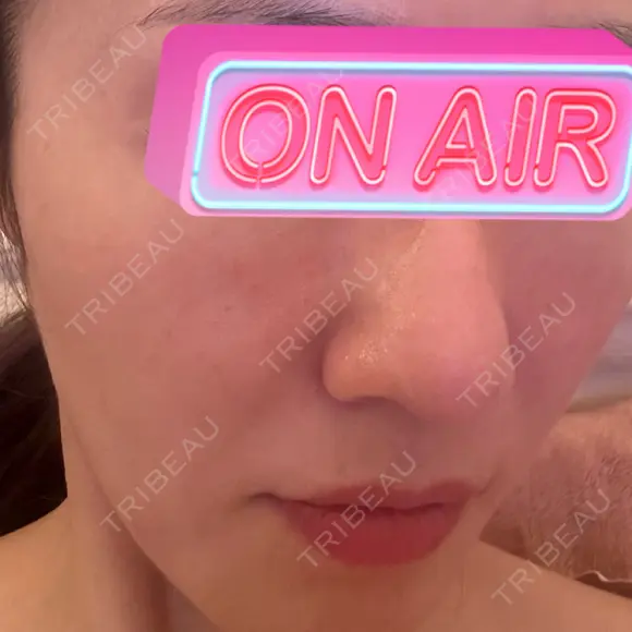 水光注射（ハリ・美肌） CHARIS BEAUTY CLINIC AFTER メイン用