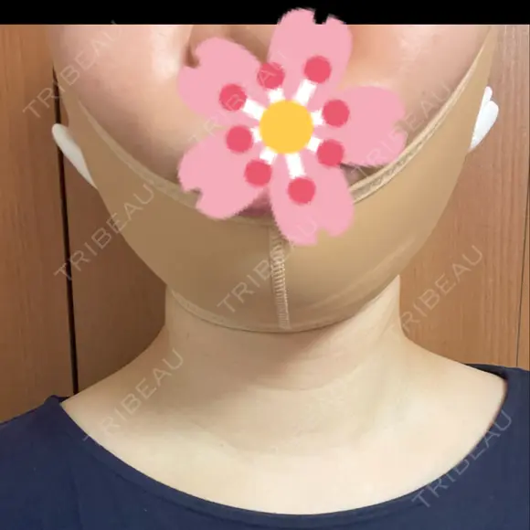 糸リフト / 脂肪吸引（顔） EMMA CLINIC（エマクリニック） DAY 1 メイン用