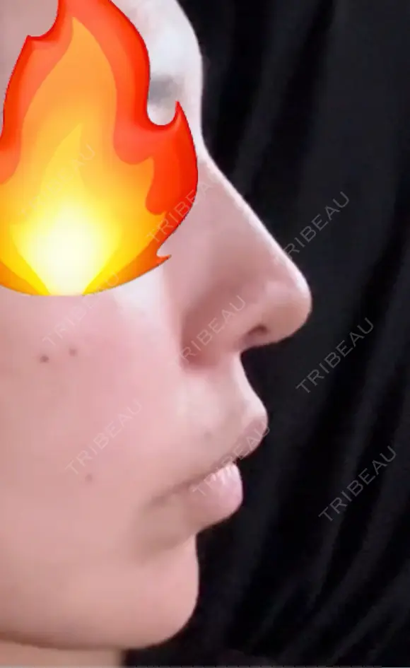 小鼻縮小（切開） / 鼻尖縮小 / 鼻柱下降・鼻唇角形成（猫手術） 東京シンデレラ美容外科 池袋院 DAY 17 メイン用