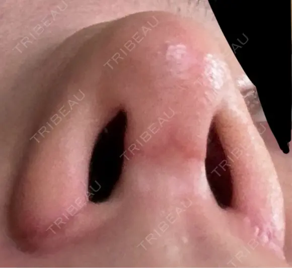 小鼻縮小（切開） / 鼻尖縮小 / 鼻柱下降・鼻唇角形成（猫手術） 東京シンデレラ美容外科 池袋院 DAY 17 メイン用