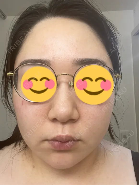 ピコレーザートーニング（美白・肝斑） / ピコフラクショナルレーザー（毛穴・ニキビ跡） おおかみ美容のクリニック 新宿院 DAY 1 メイン用