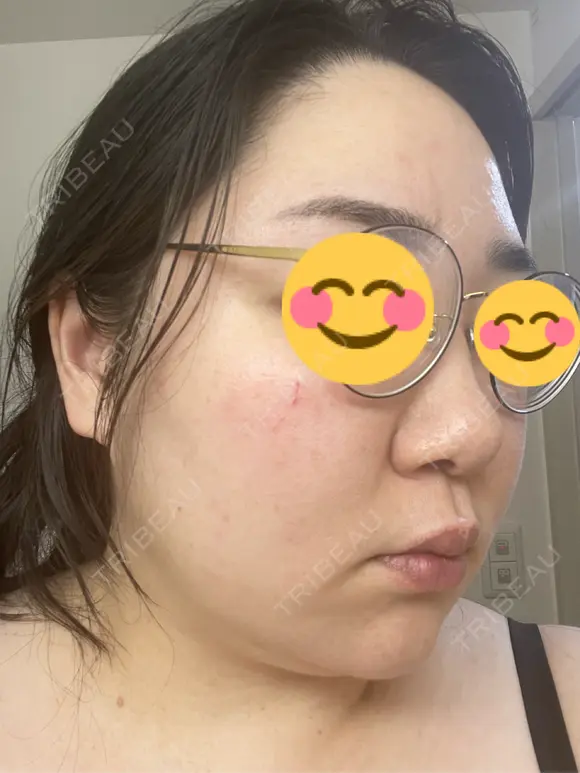 ピコレーザートーニング（美白・肝斑） / ピコフラクショナルレーザー（毛穴・ニキビ跡） おおかみ美容のクリニック 新宿院 DAY 1 メイン用