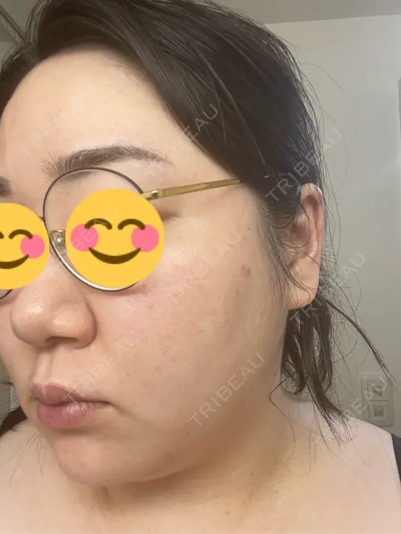 ピコレーザートーニング（美白・肝斑） / ピコフラクショナルレーザー（毛穴・ニキビ跡） おおかみ美容のクリニック 新宿院 DAY 1 メイン用