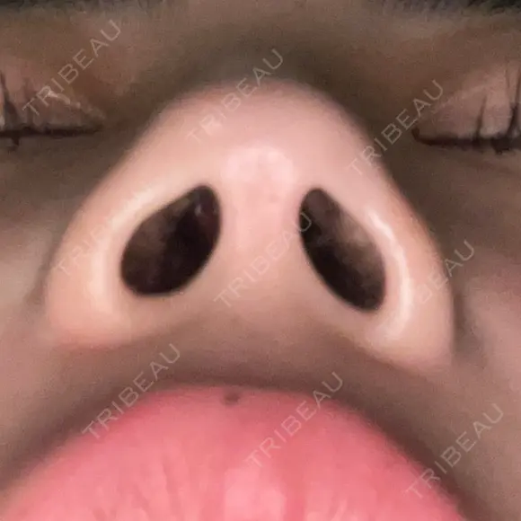 鼻中隔延長（非切開） 渋谷美容外科クリニック 渋谷院 AFTER メイン用