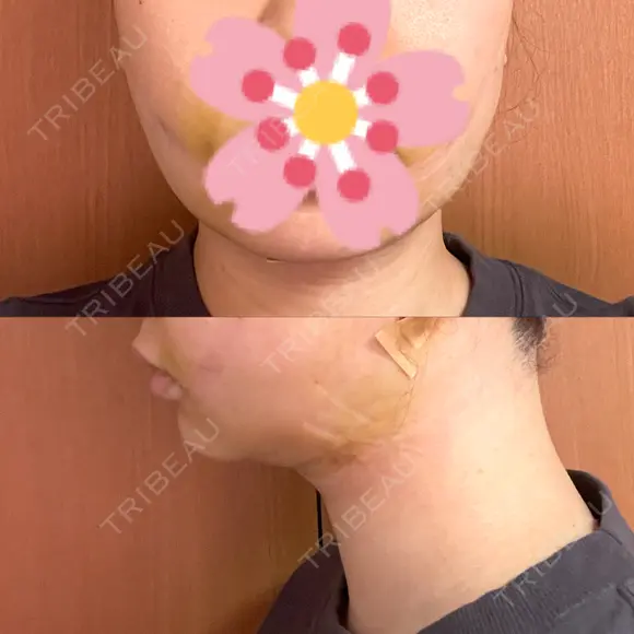 糸リフト / 脂肪吸引（顔） EMMA CLINIC（エマクリニック） DAY 3 メイン用