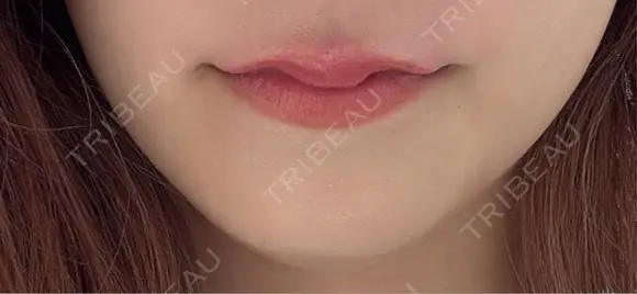 ボトックス（エラ・小顔） ルラ美容クリニック銀座院 AFTER メイン用
