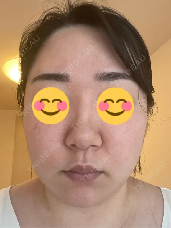 ピコレーザートーニング（美白・肝斑） / ピコフラクショナルレーザー（毛穴・ニキビ跡） おおかみ美容のクリニック 新宿院 DAY 4 メイン用