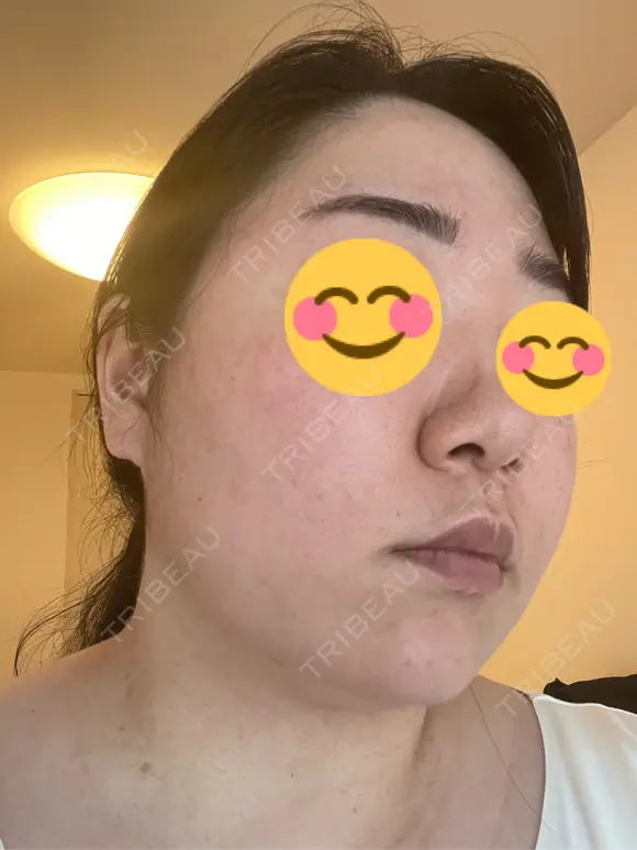 ピコレーザートーニング（美白・肝斑） / ピコフラクショナルレーザー（毛穴・ニキビ跡） おおかみ美容のクリニック 新宿院 DAY 4 メイン用