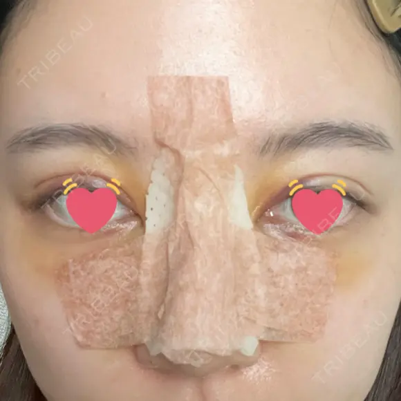 骨切幅寄せ 9BeautyClinic DAY 5 メイン用