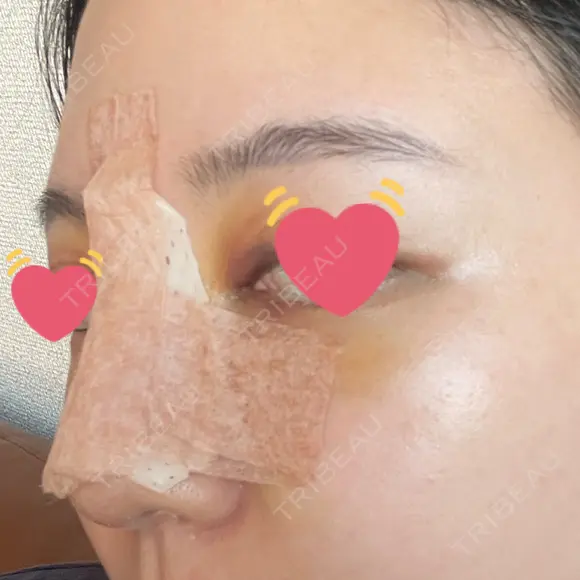 骨切幅寄せ 9BeautyClinic DAY 5 メイン用