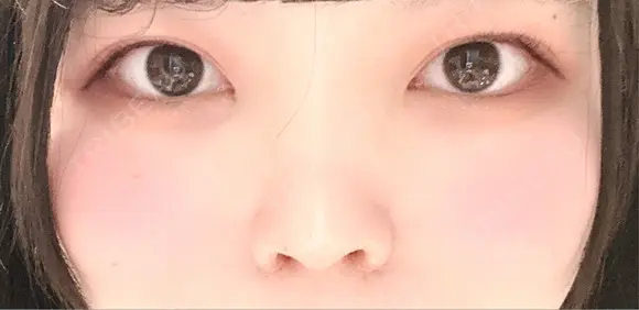 二重埋没 / 目頭切開 / 鼻尖形成（切開） / 軟骨移植 / 眉間プロテーゼ / 鼻尖縮小 グローバルビューティークリニック 大阪院 AFTER メイン用