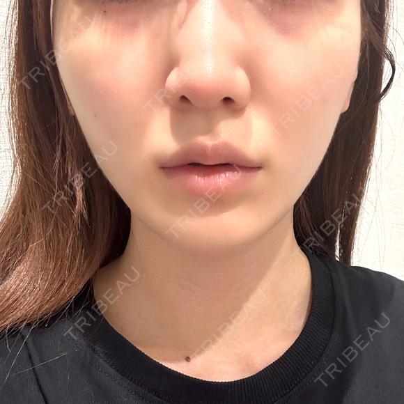 糸リフト / 脂肪吸引（顔） / ジョールファット除去 / ボトックス（エラ・小顔） R Beauty CLINIC 名古屋院 AFTER メイン用