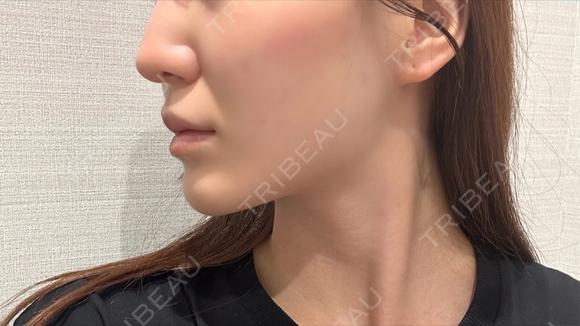 糸リフト / 脂肪吸引（顔） / ジョールファット除去 / ボトックス（エラ・小顔） R Beauty CLINIC 名古屋院 DAY 104 メイン用