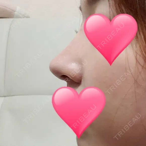 隆鼻術 / 鼻尖形成（切開） / 鼻中隔延長（切開） / 小鼻縮小（切開） / その他（鼻） / 骨切幅寄せ / 美容点滴・美容注射（美肌） FROM B整形外科 (旧バウム整形外科) DAY 17 メイン用