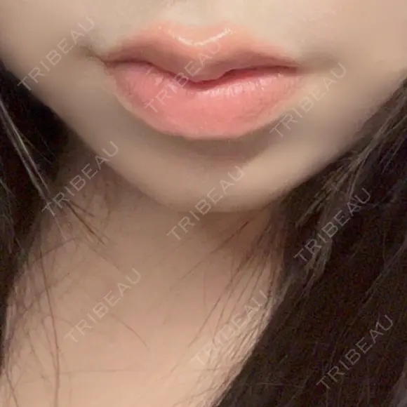 ヒアルロン酸注入（涙袋） / ヒアルロン酸注入（唇） 共立美容外科 梅田院 AFTER メイン用