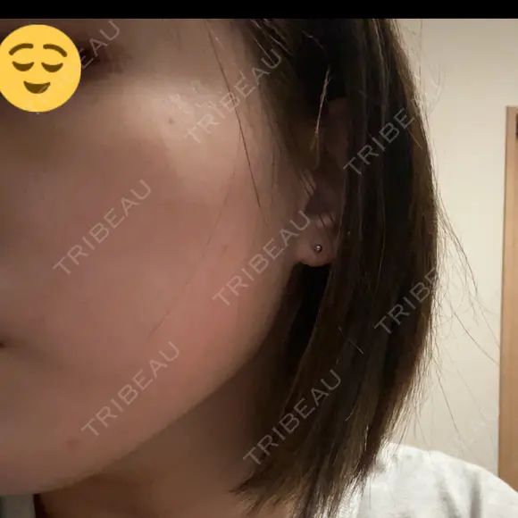 ボトックス（エラ・小顔） BiBiクリニック DAY 4 メイン用