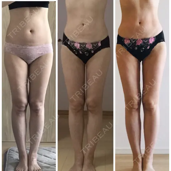 脂肪吸引（脚） / 脂肪吸引（お腹） / 脂肪吸引（お尻） ラインカルチャークリニック AFTER メイン用