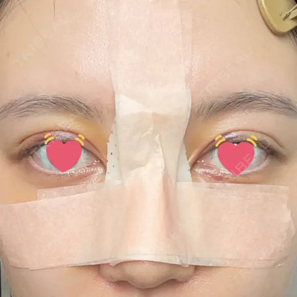 骨切幅寄せ 9BeautyClinic DAY 6 メイン用