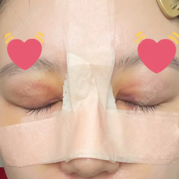骨切幅寄せ 9BeautyClinic DAY 6 メイン用