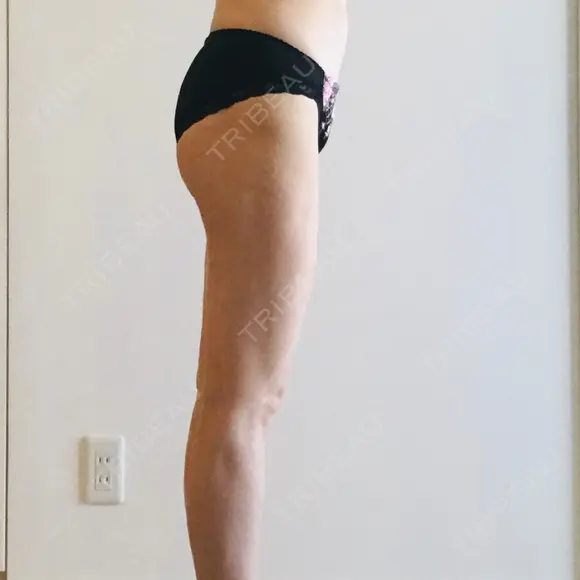 脂肪吸引（脚） / 脂肪吸引（お腹） / 脂肪吸引（お尻） ラインカルチャークリニック DAY 386 メイン用