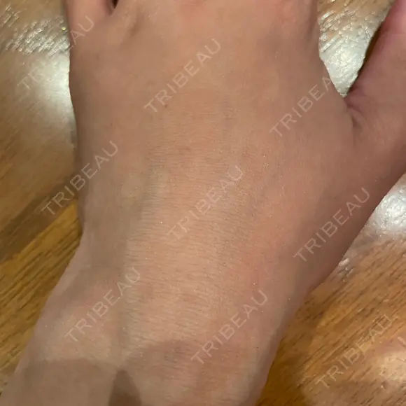 脂肪注入（肌） EMMO FACE CLINIC 大阪梅田院 DAY 7 メイン用