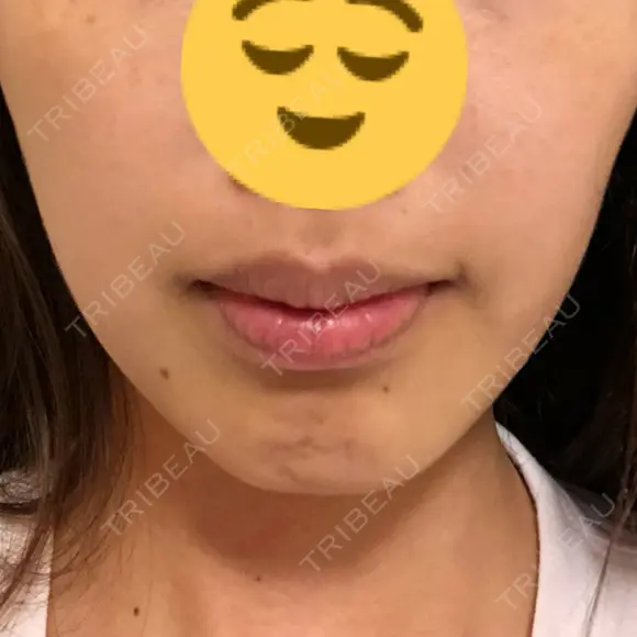 ボトックス（額） / その他（肌） Kaleido Clinic（カレイドクリニック） 横浜 AFTER メイン用