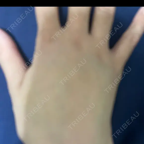 脂肪注入（肌） EMMO FACE CLINIC 大阪梅田院 DAY 8 メイン用