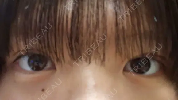 二重埋没 ルラ美容クリニック 渋谷本院 DAY 3 メイン用