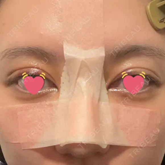 骨切幅寄せ 9BeautyClinic DAY 7 メイン用