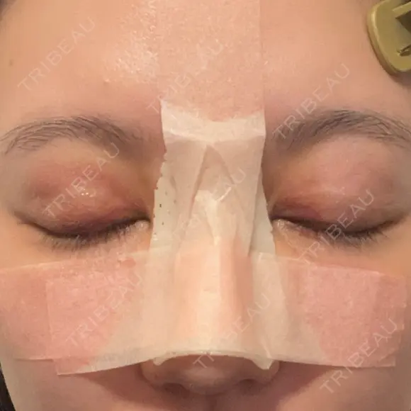 骨切幅寄せ 9BeautyClinic DAY 7 メイン用