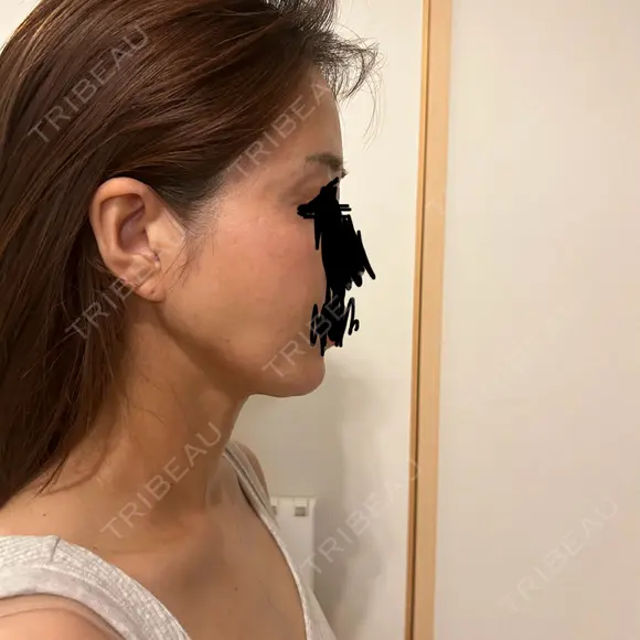 脂肪注入（額） Mods Clinic（モッズクリニック） 福岡院 AFTER メイン用