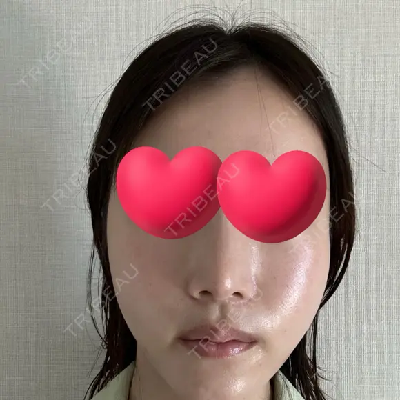 脂肪注入（輪郭） / PRP皮膚再生療法 EMMO FACE CLINIC 大宮院 DAY 1 メイン用