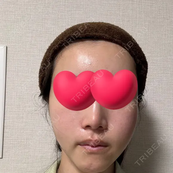脂肪注入（輪郭） / PRP皮膚再生療法 EMMO FACE CLINIC 大宮院 DAY 2 メイン用