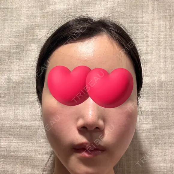 脂肪注入（輪郭） / PRP皮膚再生療法 EMMO FACE CLINIC 大宮院 DAY 3 メイン用