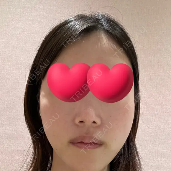 脂肪注入（輪郭） / PRP皮膚再生療法 EMMO FACE CLINIC 大宮院 DAY 4 メイン用